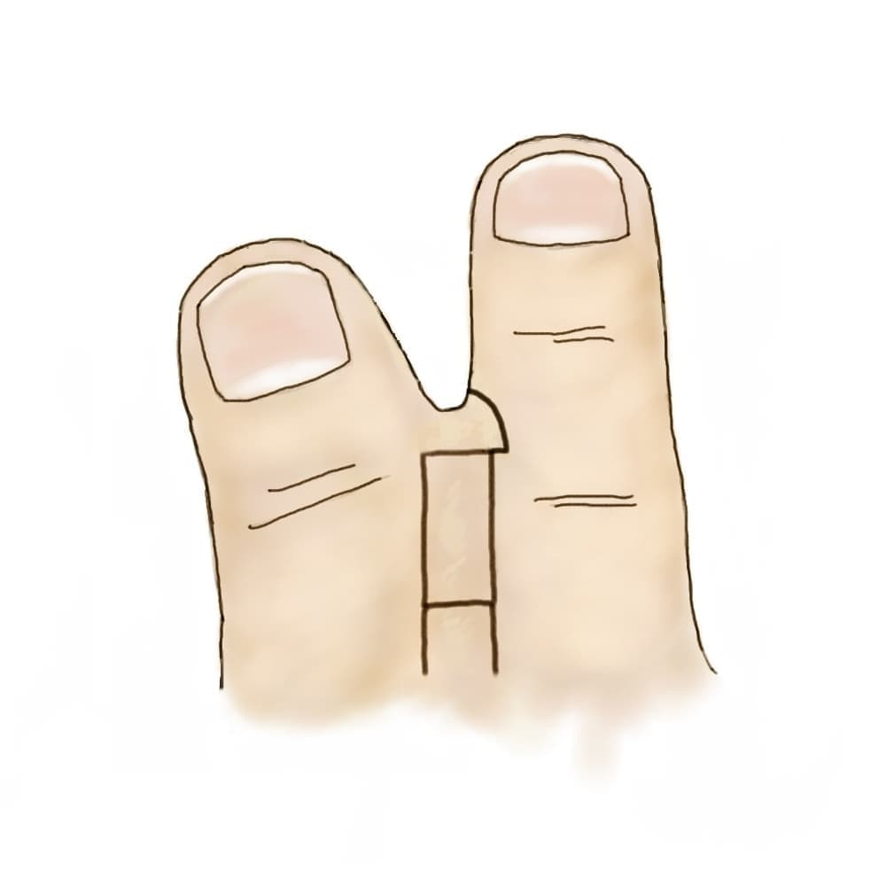 形成外科論文に掲載された手術シェーマ PRS Global Open (2016)