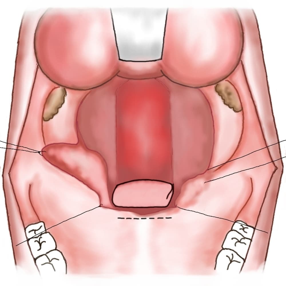 形成外科論文に掲載された手術シェーマ JPRAS Open (2017)