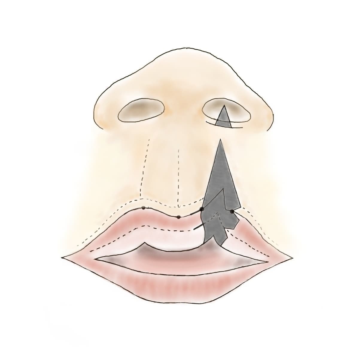 形成外科論文に掲載された手術シェーマ European Journal of Plastic Surgery (2016)